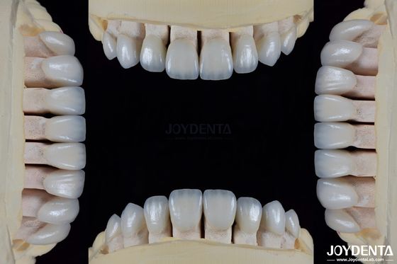 Doğal Estetik için Keramik Diş Finerleri leke direnci parlaklığını korur Sağlam uyum için diş mendili ile güçlü bağ