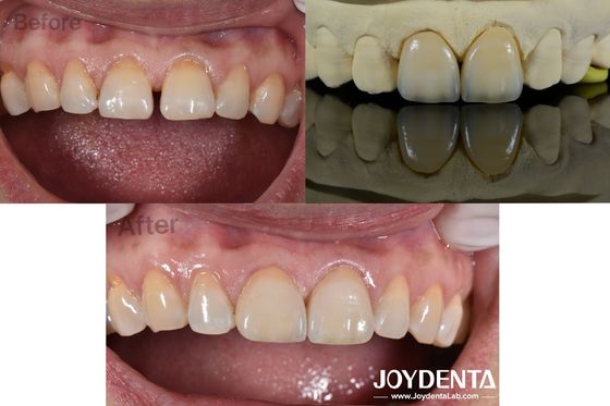 0.5mm Kalınlıklı Diş Fineri Mükemmel Permeabillik Açık Dişler İçin Porselen Fineri