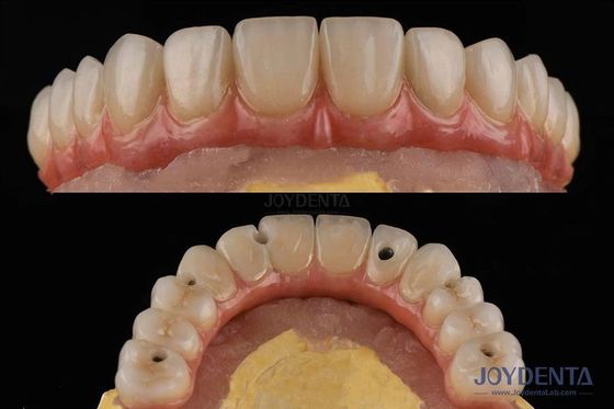 satın al Kaba yüzey diş implantı platformu iç bağlantılı diş köprüleri Çevrimiçi üretim