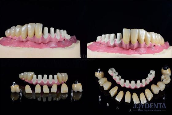satın al Çoklu Endosöz Diş İmplantları Tam Kemer Restorasyonu İç Bağlantısı Çevrimiçi üretim