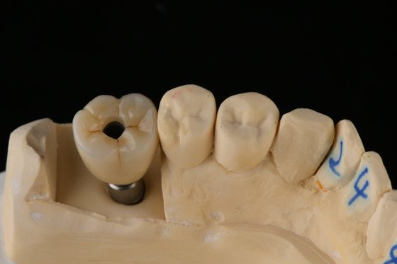 satın al 3.75mm Gümüş Titanyum vida diş implantı Tek Diş Değiştirme implantı Çevrimiçi üretim