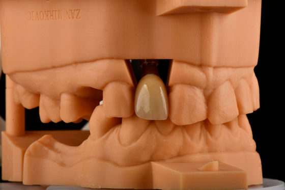 satın al İç Hex 3.0mm Derinlik 1.5mm Pitch Tek Titanyum Diş İmplantı Değiştirme Çevrimiçi üretim