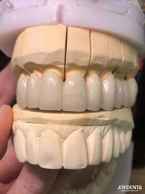 satın al Precision Fit Porselen Metal PFM Taçları Dikişsiz Doğal Gülümseme Geliştirme Çevrimiçi üretim