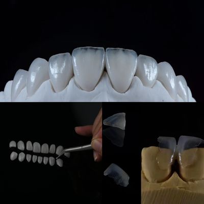 satın al Cam Keramik Finer Bu Üstün Diş Çözümüyle Doğal Görünümlü Bir Gülümsemeyi Sağlayın Çevrimiçi üretim