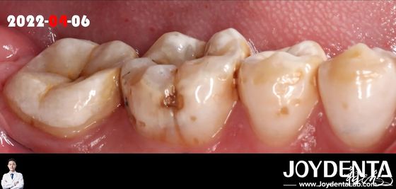 satın al Doğal Renkli, Hasarlı Dişlerin Yenilenmesi İçin Dental Inlay Çevrimiçi üretim