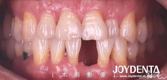 satın al Ön ve premolar dişler için özelleştirilebilir diş Maryland reçine bağlanmış köprüler Çevrimiçi üretim