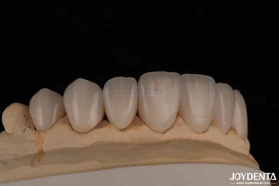 satın al Feldspathic Doğal Görünümlü Kozmetik Finerler Kesin Uygunluk Yüksek Şeffaflık Çevrimiçi üretim