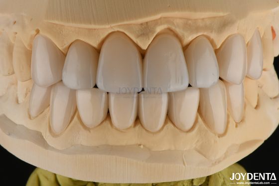 satın al 0.3-0.5mm Kalınlıklı Feldspatik Porselen Finer Yüksek Kırık Direnci Gülümsemenizi Geliştirin Çevrimiçi üretim