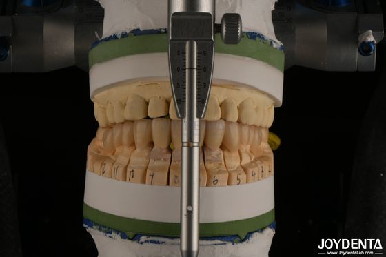 satın al Yüksek Estetik Porselen Katmanlı Dental Zirkonya İmplant Restorasyonları İçin Çevrimiçi üretim