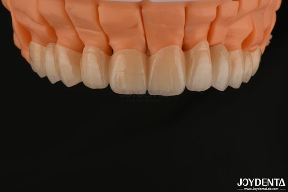 satın al Yüksek Estetik Katmanlı Zirkonya Tek Taç Köprüleri Diş Restorasyonları için İmplant Çevrimiçi üretim
