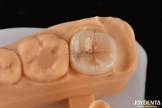 satın al 0.5mm-2mm Precise Fit Emax Dental Inlay Onlay Güvenilir Diş Restorasyonu İçin Çevrimiçi üretim