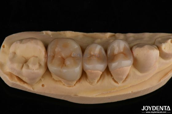 satın al Doğal Görünümlü Emax Inlay Onlay Uzun Sürekli Diş Restorasyonu 0.5mm 1mm 1.5mm Kalınlığı Çevrimiçi üretim