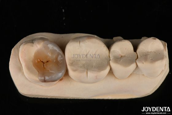satın al Doğal Görünümlü Emax Diş Restorasyonu İçin Özel Diş Eklemleri ve Onlaylar Çevrimiçi üretim