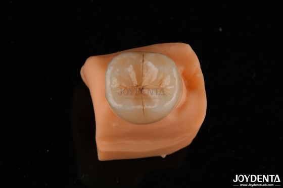 satın al 0.5mm lekeye dayanıklı Emax Inlay Onlay Diş Restorasyonları için Tam Uyumlu Çevrimiçi üretim