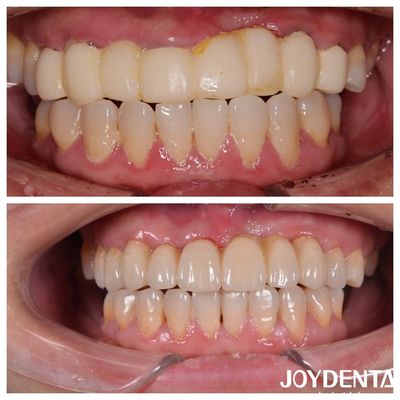 satın al Doğal Renkli Çok Katmanlı Diş Zirkonya Köprüleri Optimal Hasta Deneyimi İçin Çevrimiçi üretim