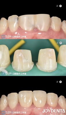 satın al Kesinlikle uyumlu dişler Zirkonya diş taçları hassas üretim için CAD CAM sistemleriyle Çevrimiçi üretim