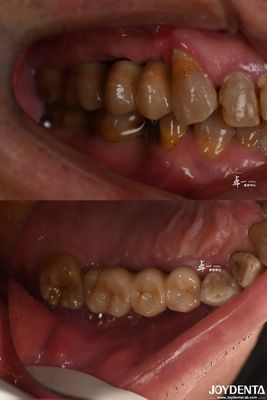 satın al Çarpık yüzey tasarımı, kemik seviyesindeki titanyum malzemesi için diş implantı Çevrimiçi üretim