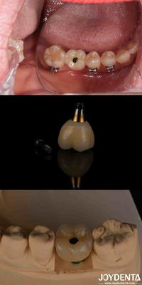 satın al 4-6 Diş Endosseous Conical Implant Subcrestal Kemik Seviyesi Ve İç Hex Bağlantısı Çevrimiçi üretim
