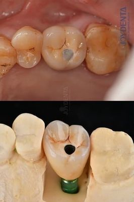 satın al Titanyum tam kemerli diş implantları olağanüstü dayanıklılık için protez platform 4.1mm Çevrimiçi üretim