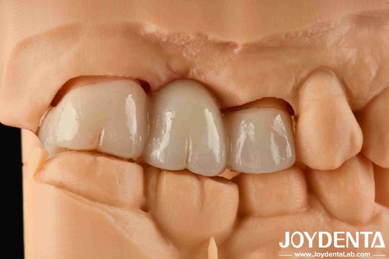 satın al Renk deneyimi Gerçekçi Tam Zirkonya Renklemeye Yüksek Direnci ve 1000 MPa'lık Eğiliş Gücü Çevrimiçi üretim