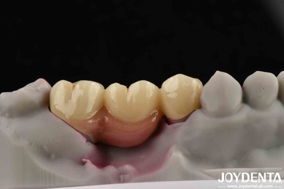 satın al Dental implantlar için özelleştirilebilir diş implantı desteklenmiş köprü ve taç Çevrimiçi üretim
