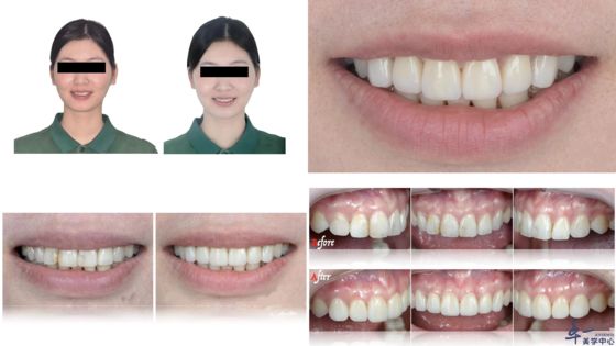 satın al Joydentalab'ın popüler ürünleri: Simülasyonlu estetik kaplamalar Çevrimiçi üretim