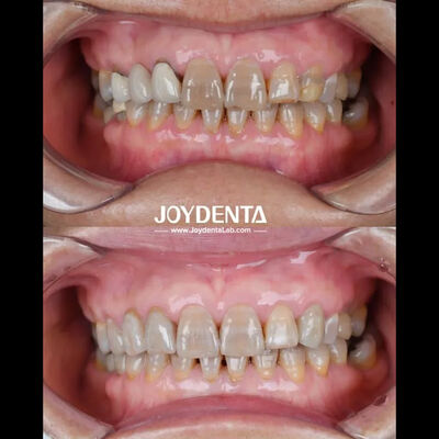 satın al En iyi hasta deneyimi için hafif diş zirkonisi doğal renk Çevrimiçi üretim