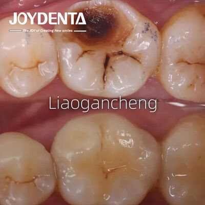 satın al Yetişkinler ve Çocuklar İçin Porselen Diş Ekimi Restoratif Çevrimiçi üretim