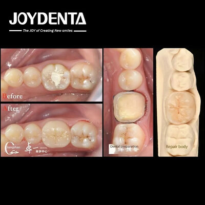 satın al Doğal Diş Restorasyonu ile Biyolojik Uyumluluk ve Yüksek Uyumluluk Çevrimiçi üretim