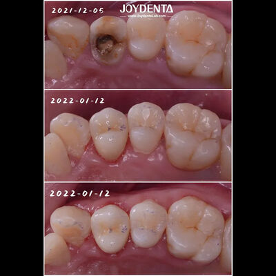 satın al Hassas Uyumlu Diş Porselen Onlay Hasarlı Diş Restorasyonu Çevrimiçi üretim