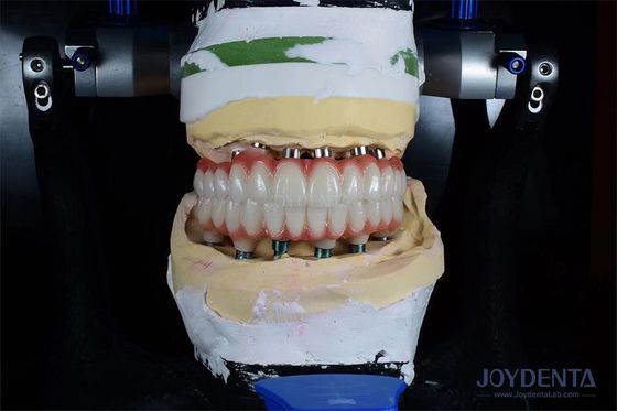 En iyi ameliyat sonuçları için 10 mm uzunluğunda tek diş implantı gamma ışınlanması.