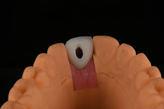 Sertleştirilmiş yüzey titanyum diş implantları Ön diş değiştirme ameliyatı