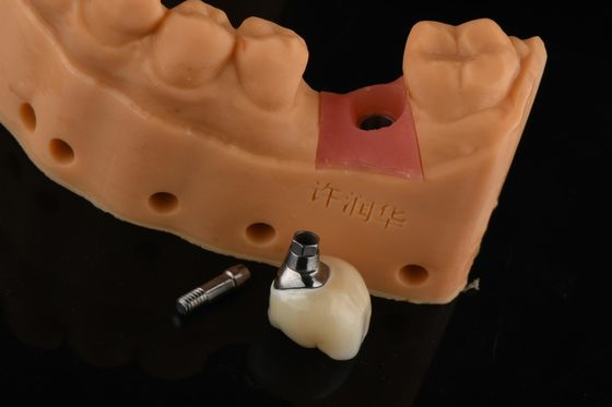 Kesinlikle Silindirik Gümüş Tek Diş Değiştirme Dental Restorasyon