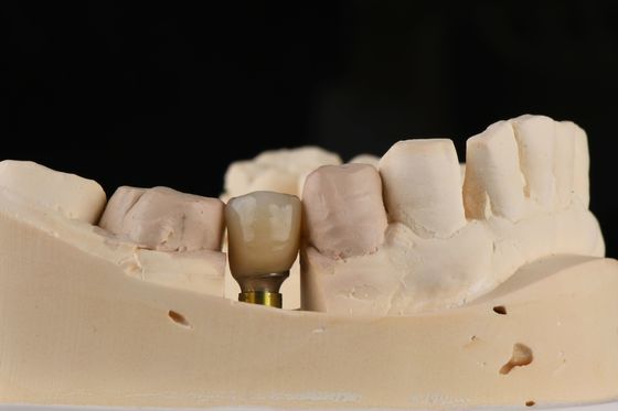 Kendi kendine dokunan iplik ve iç altılık bağlantısı olan kum püskürtülen tek diş implantı