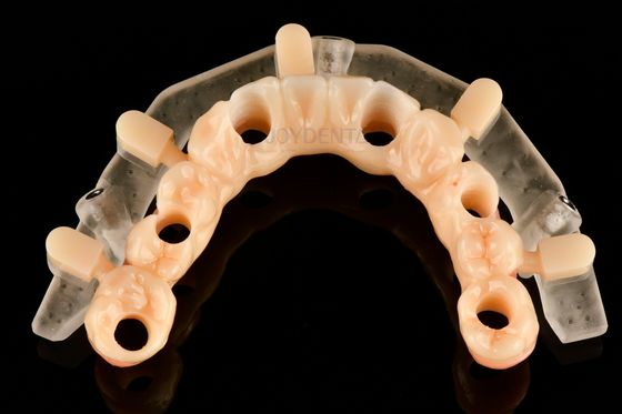 Tam implant yerleştirme için özel hassas 3D basılı yönlendirilmiş cerrahi şablonları