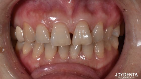 0.5mm Kalınlığı Seramik Diş Finerleri Doğal Ön Diş İfade Arama