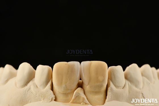 0.2mm Kalınlığı Mikrotin Finerleri Ön Dişler İçin Cam Keramik Diş Finerleri