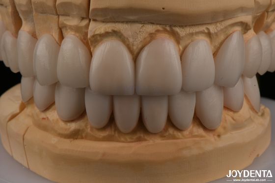 0.3mm Kalınlığı Ips Emax Finerler Seramik Finerler Ön Arka Restorasyonlar