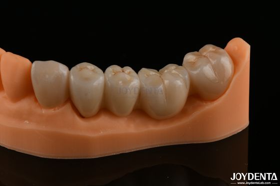 Kesin Diş Restorasyonları Tam Zirkonya Yüksek Eğiliş Gücü Doğal Renk