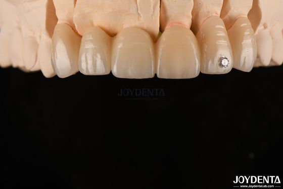 CAD / CAM freze diş katmanlı zirkonya tek taçlar için 0.3-0.5mm katman kalınlığı