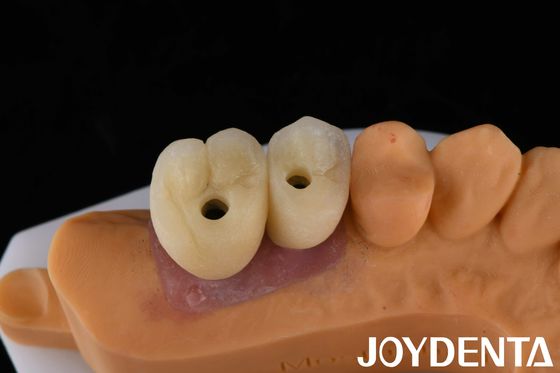Porselen İmplant Tacı ve Köprüsü Kayıp Dişlerin Yenilenmesi İçin Nihai Çözüm