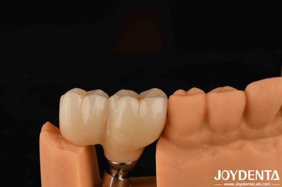 V şeklinde iplik türü bitmiş abutments Tüm büyük implant sistemleri ile uyumluluk