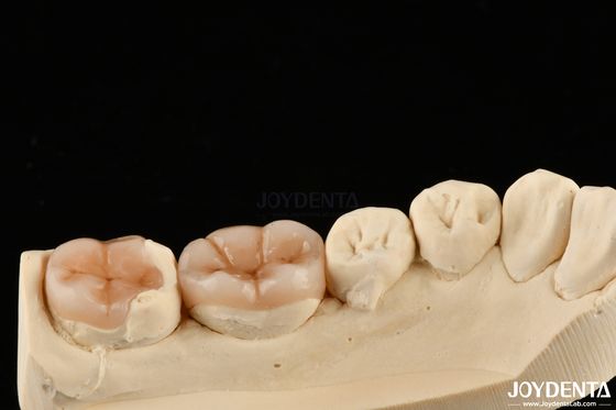 Doğal Görünümlü Kompozit Inlay Onlay Doğal Görünümlü Diş Restorasyonu