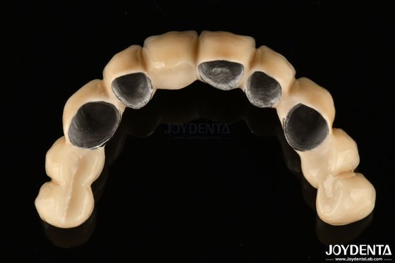 PFM Metal Tacı'na Erimiş Keramik Yüksek Biyo Uyumlu ve Korozyona Dirençli
