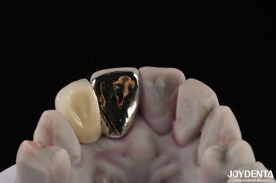 Metal Dental Maryland Köprüsü Uzun Süren Tedavi İçin İyi Çiğneme Fonksiyonu