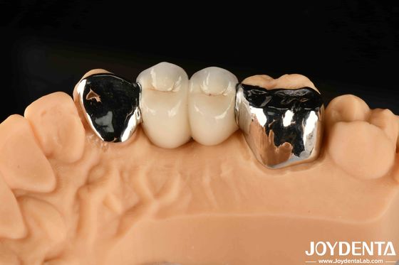 Metal Diş Maryland Bağlı Köprü Ağız Klinik Onarım için İyi Tedavi