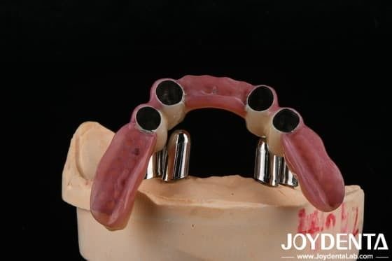 Dental hassasiyet takıntıları kısmi diş protezleri doğru restorasyonlar