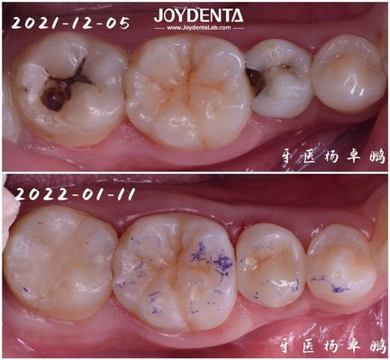 Yüksek Dayanıklılık Hasarlı Dişler İçin Diş Restorasyonu Çeşitli Boyutlarda