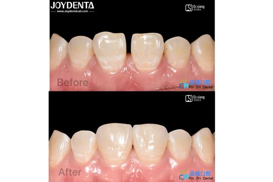 Güvenli Yapışkan Porselen Finerler Diş Tedavisi Kompozit reçine finerler leke karşıtı