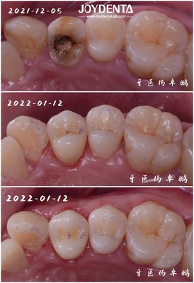 Dental Porselen Inlay Hasarlı Dişlerin Yenilenmesi Büyükler ve Çocuklar İçin